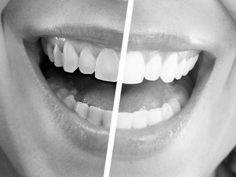 Philips Zoom Whitening Dr. Charles S. Ireland III